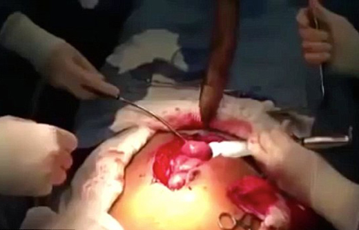 fish is remove...